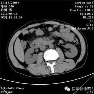 【病例】十二指肠粘膜相关淋巴瘤1例CT影像表现