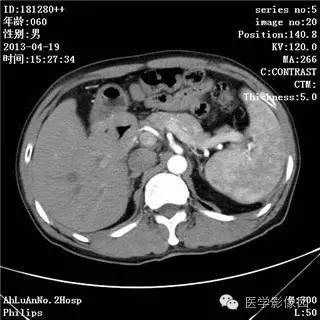 【病例】十二指肠粘膜相关淋巴瘤1例CT影像表现