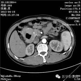 【病例】十二指肠粘膜相关淋巴瘤1例CT影像表现