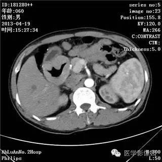 【病例】十二指肠粘膜相关淋巴瘤1例CT影像表现