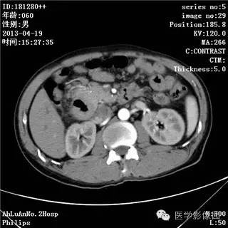 【病例】十二指肠粘膜相关淋巴瘤1例CT影像表现