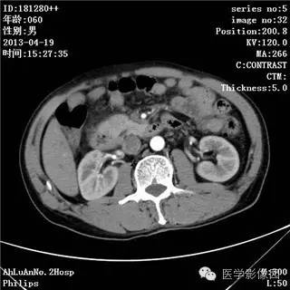 【病例】十二指肠粘膜相关淋巴瘤1例CT影像表现