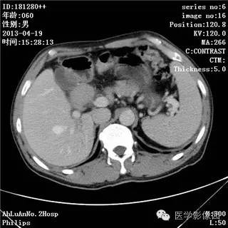 【病例】十二指肠粘膜相关淋巴瘤1例CT影像表现