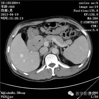 【病例】十二指肠粘膜相关淋巴瘤1例CT影像表现