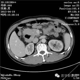 【病例】十二指肠粘膜相关淋巴瘤1例CT影像表现