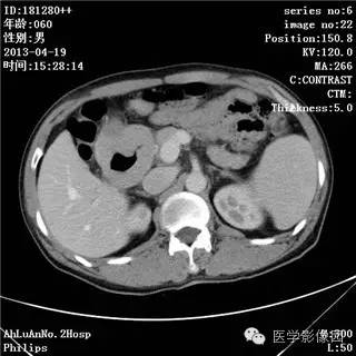 【病例】十二指肠粘膜相关淋巴瘤1例CT影像表现