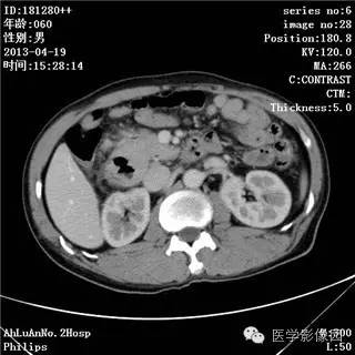 【病例】十二指肠粘膜相关淋巴瘤1例CT影像表现