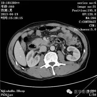 【病例】十二指肠粘膜相关淋巴瘤1例CT影像表现