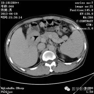 【病例】十二指肠粘膜相关淋巴瘤1例CT影像表现
