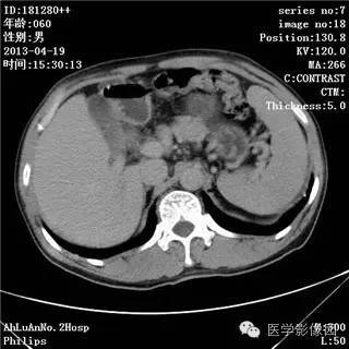 【病例】十二指肠粘膜相关淋巴瘤1例CT影像表现