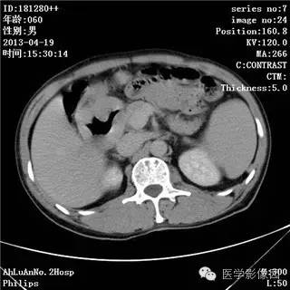 【病例】十二指肠粘膜相关淋巴瘤1例CT影像表现