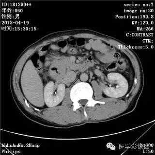 【病例】十二指肠粘膜相关淋巴瘤1例CT影像表现
