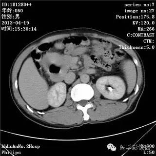 【病例】十二指肠粘膜相关淋巴瘤1例CT影像表现