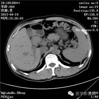 【病例】十二指肠粘膜相关淋巴瘤1例CT影像表现