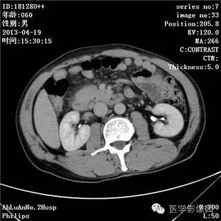 【病例】十二指肠粘膜相关淋巴瘤1例CT影像表现