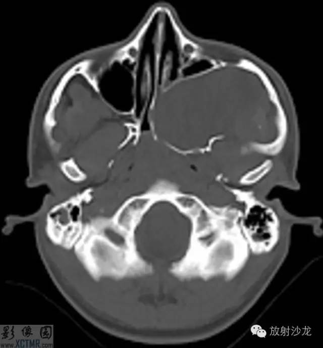 【病例】翼腭窝占位性病变1例MR影像表现