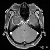 【病例】右侧颞极表皮样囊肿1例影像表现 【病例】右侧颞极表皮样囊肿1例影像表现