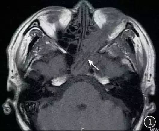 【病例】眶颅底巨大异物残留1例MR影像表现