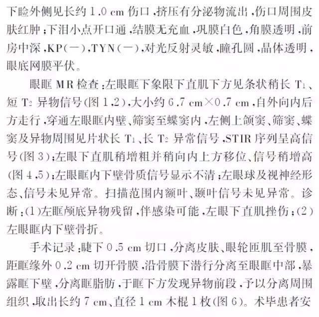 【病例】眶颅底巨大异物残留1例MR影像表现