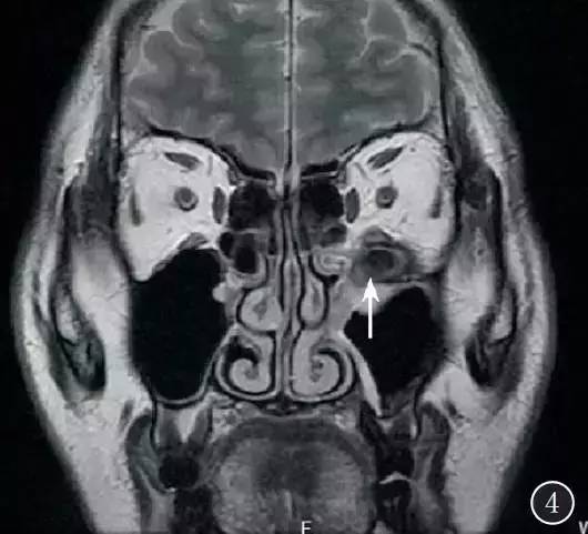 【病例】眶颅底巨大异物残留1例MR影像表现