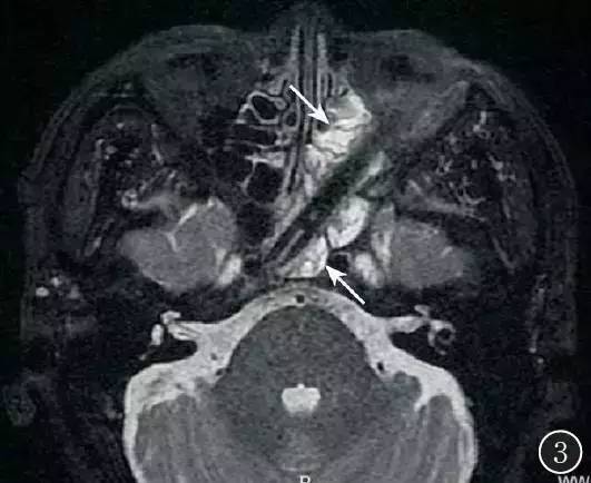 【病例】眶颅底巨大异物残留1例MR影像表现