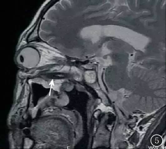 【病例】眶颅底巨大异物残留1例MR影像表现