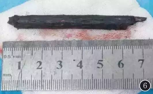 【病例】眶颅底巨大异物残留1例MR影像表现