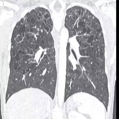 肺朗格汉斯组织细胞增生症PLCH 肺朗格汉斯组织细胞增生症PLCH