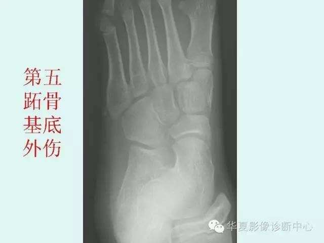 【PPT】骨骺？骨折？要分清