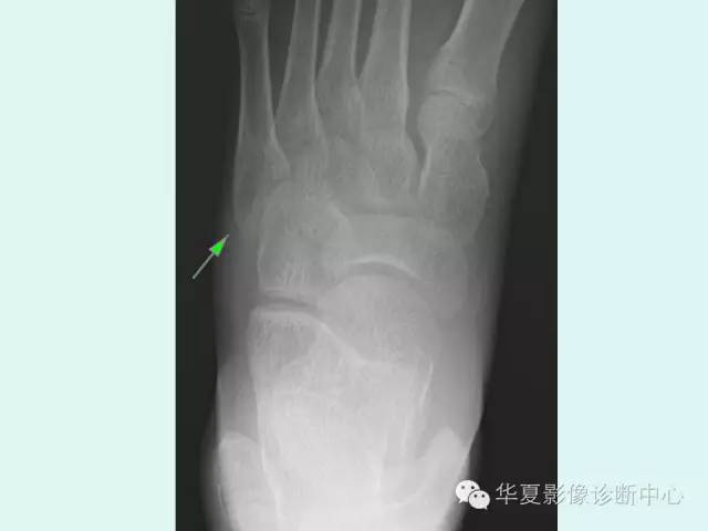 【PPT】骨骺？骨折？要分清