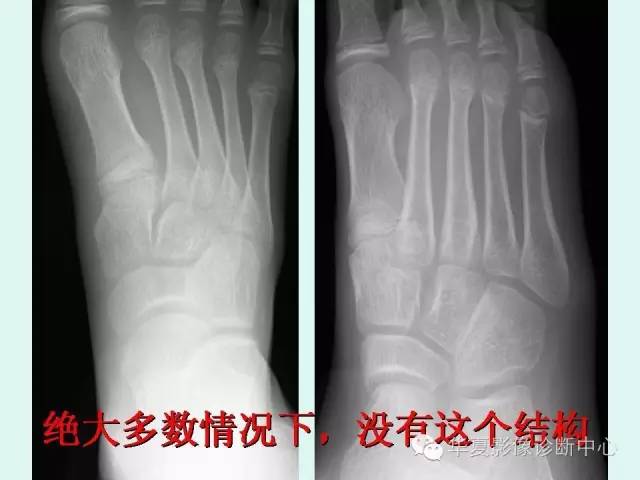 【PPT】骨骺？骨折？要分清