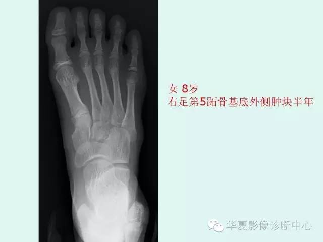 【PPT】骨骺？骨折？要分清