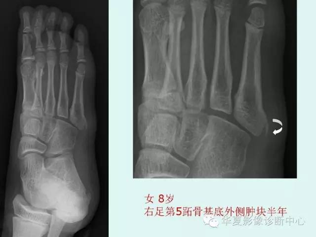 【PPT】骨骺？骨折？要分清