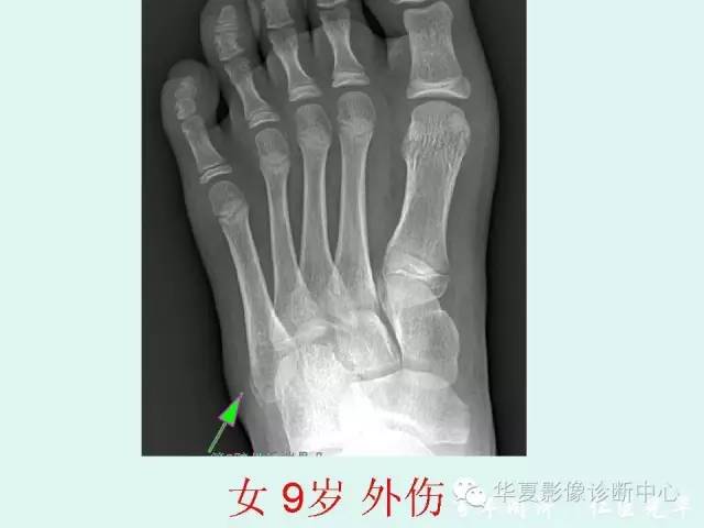 【PPT】骨骺？骨折？要分清