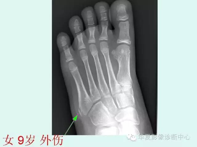 【PPT】骨骺？骨折？要分清