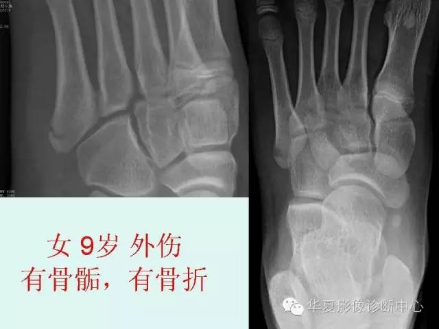 【PPT】骨骺？骨折？要分清