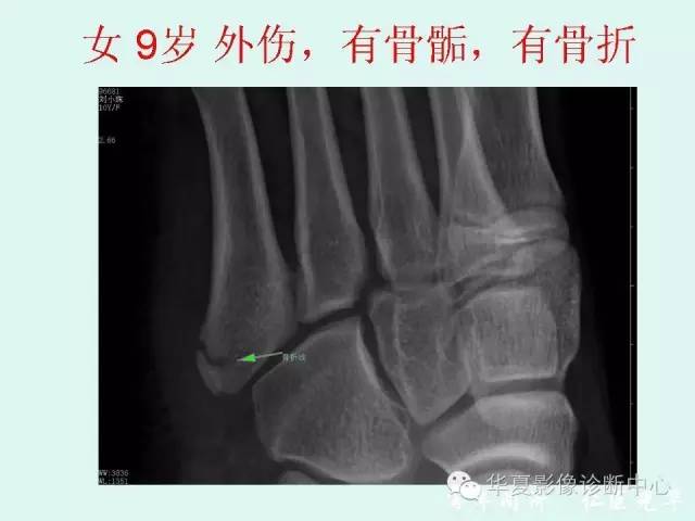 【PPT】骨骺？骨折？要分清