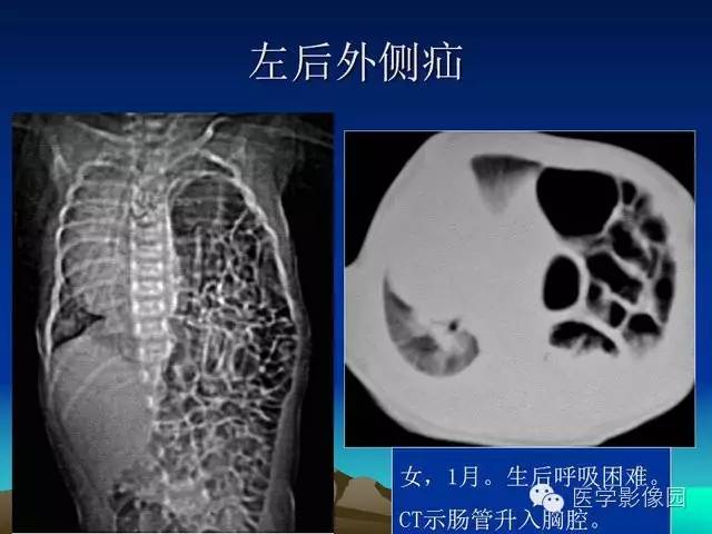 【PPT】膈疝的影像学诊断
