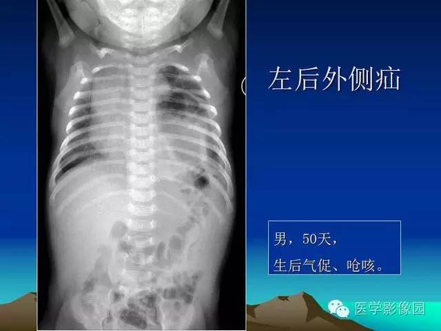 【PPT】膈疝的影像学诊断