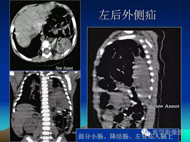 【PPT】膈疝的影像学诊断