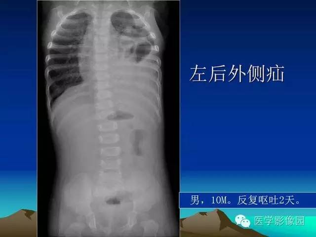 【PPT】膈疝的影像学诊断