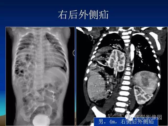 【PPT】膈疝的影像学诊断