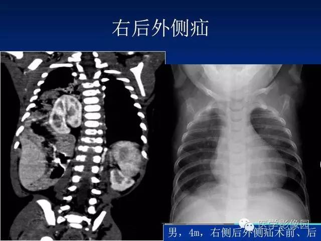 【PPT】膈疝的影像学诊断