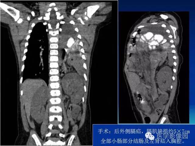 【PPT】膈疝的影像学诊断