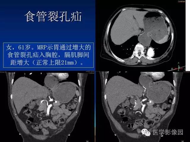 【PPT】膈疝的影像学诊断