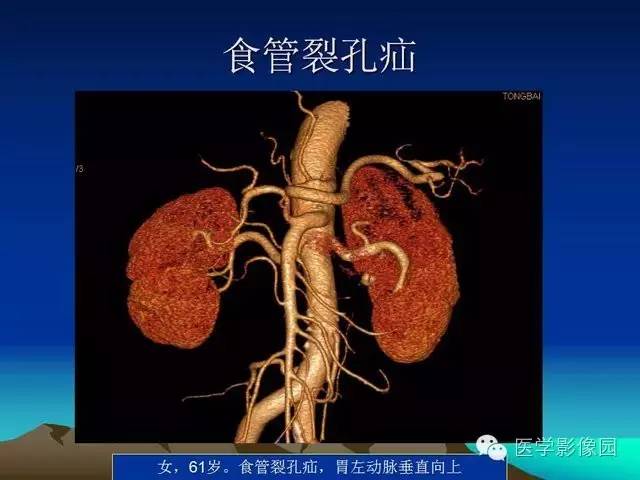 【PPT】膈疝的影像学诊断