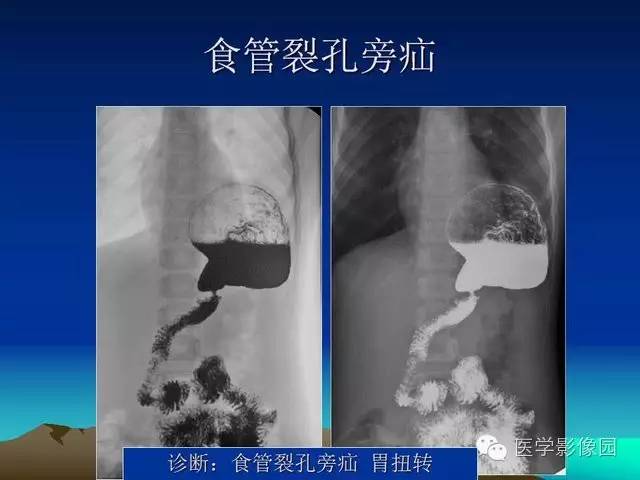 【PPT】膈疝的影像学诊断