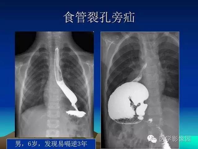 【PPT】膈疝的影像学诊断