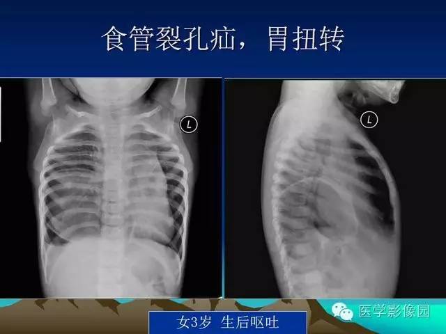 【PPT】膈疝的影像学诊断