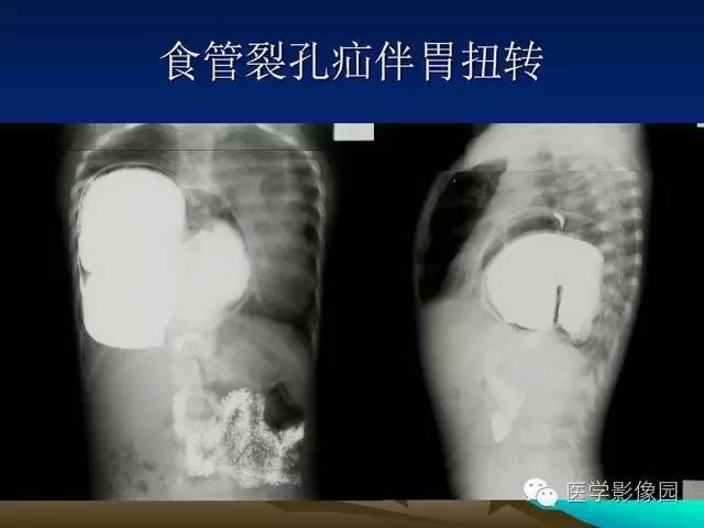 【PPT】膈疝的影像学诊断